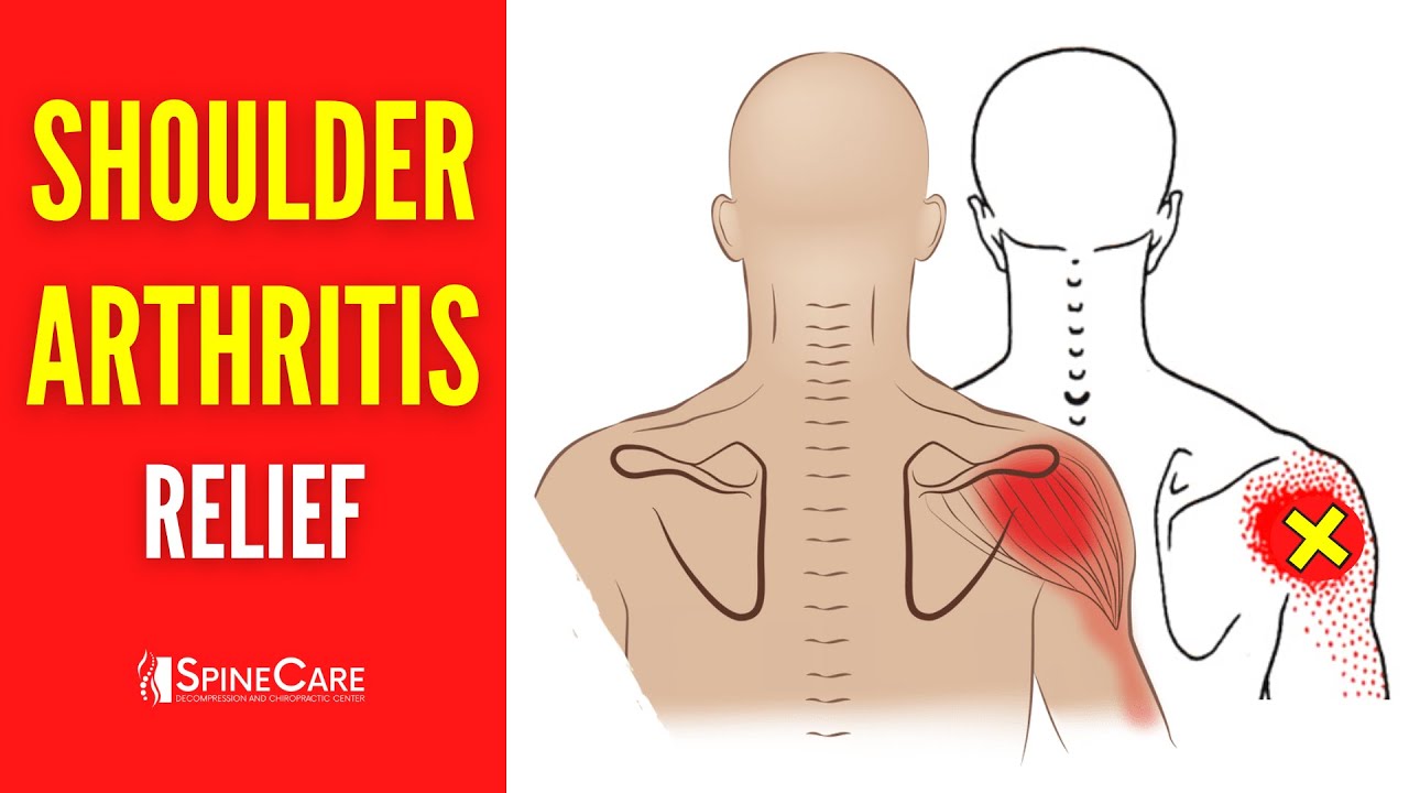 How to Relieve Shoulder Arthritis Pain in 30 SECONDS