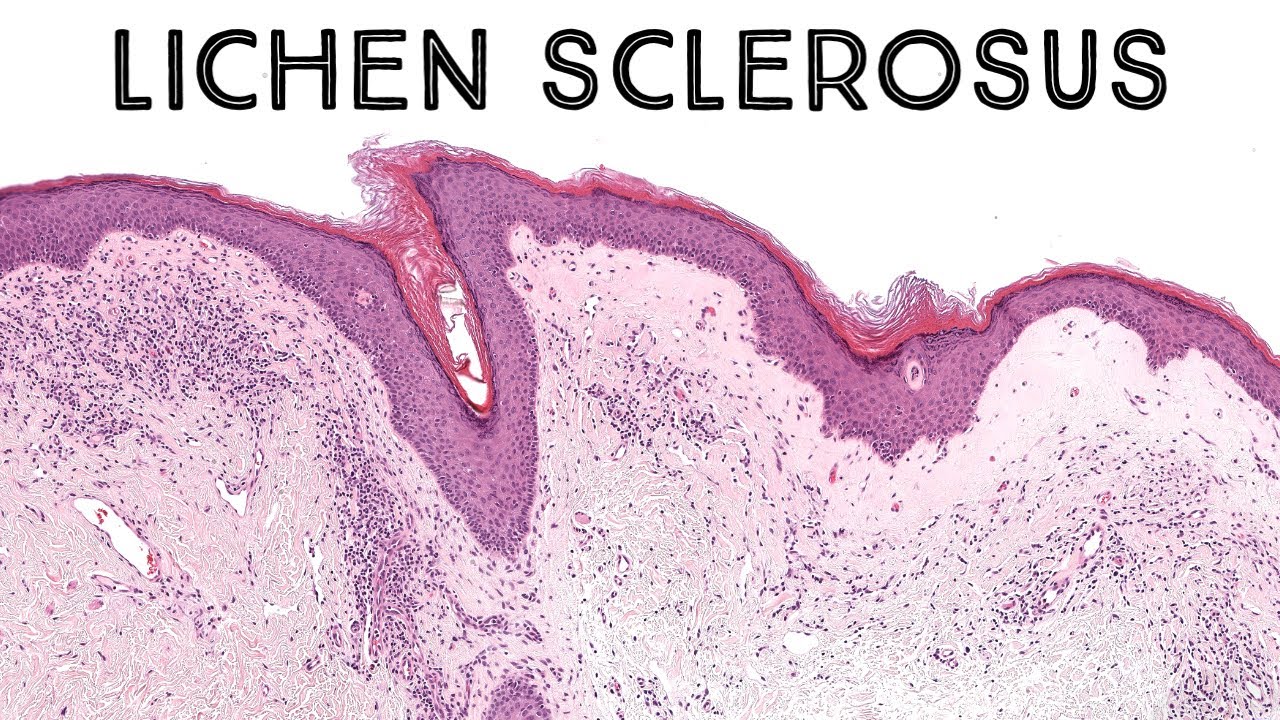 Lichen sclerosus with epidermotropism (mimic of mycosis fungoides) pathology dermatology dermpath