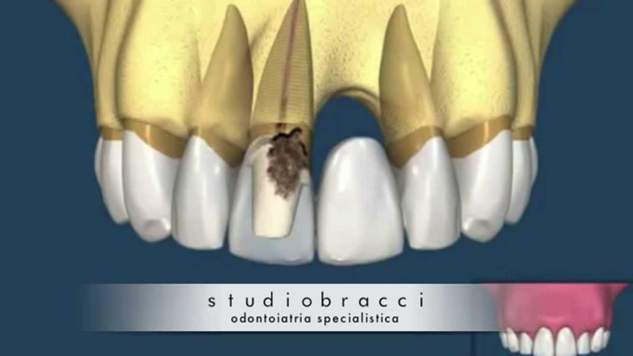 Ponte dentale eseguito scorrettamente
