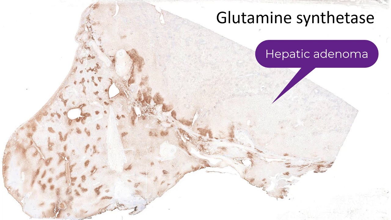 Inflammatory Hepatic Adenoma
