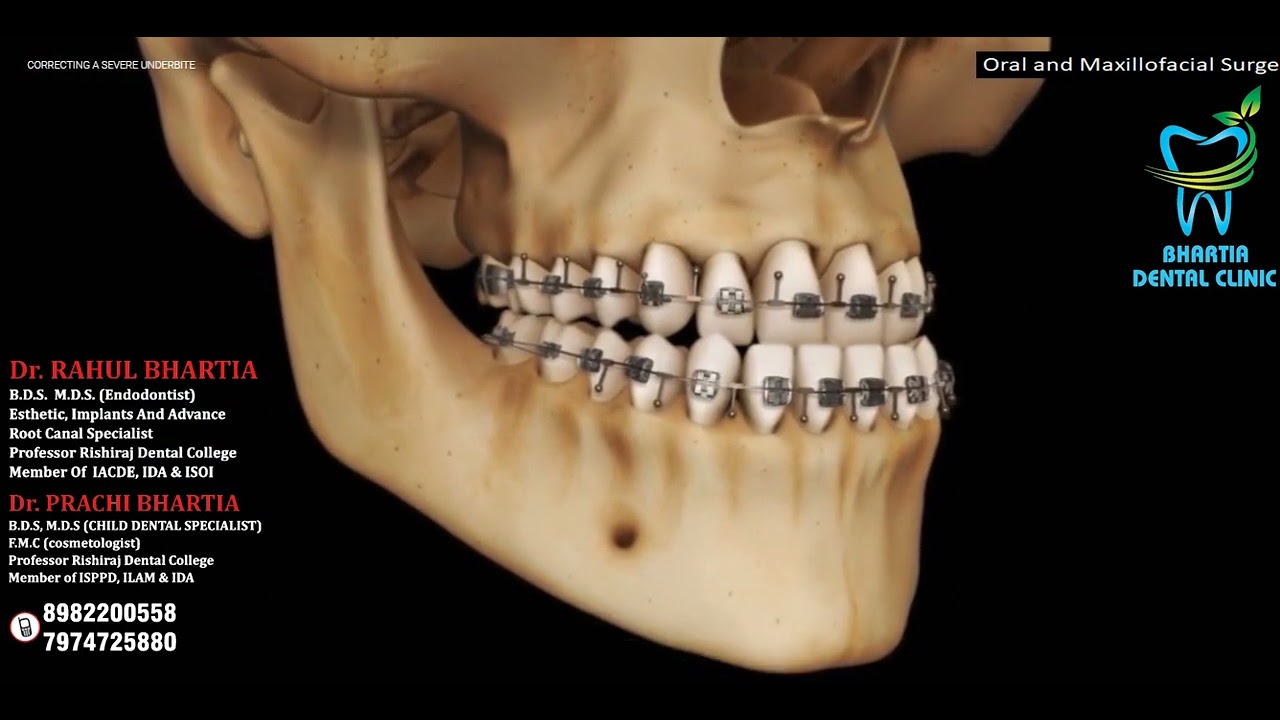Jaw Advancement Surgery Explained: Bilateral Sagittal Split Osteotomy