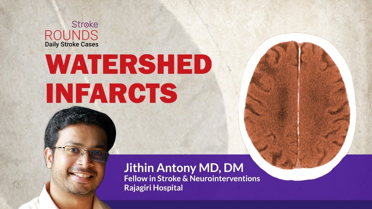 Stroke Rounds -13 - Watershed Infarcts -Dr Jithin Antony