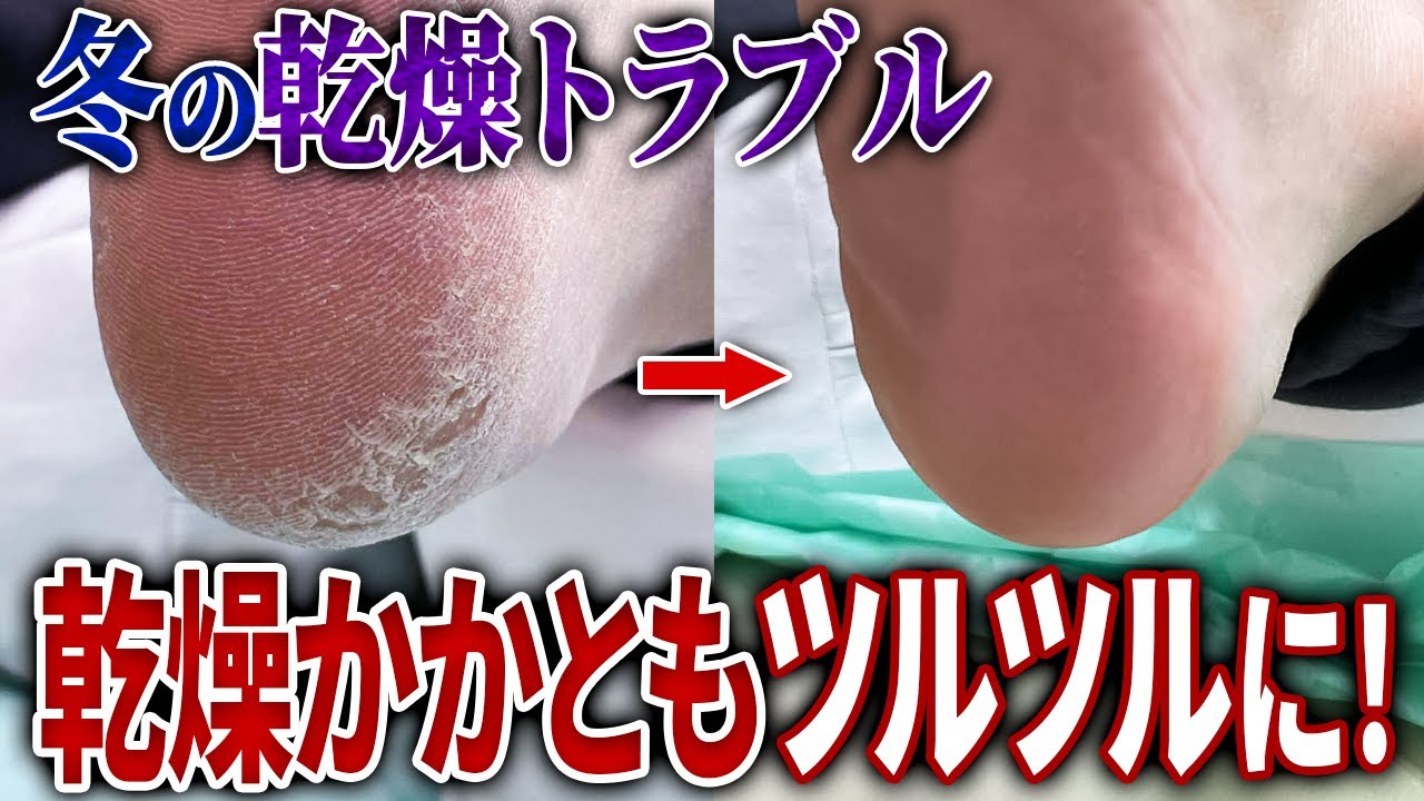 冬に多いかかとの乾燥は保湿だけじゃ解決しない！間違った対応は乾燥を繰り返すだけです