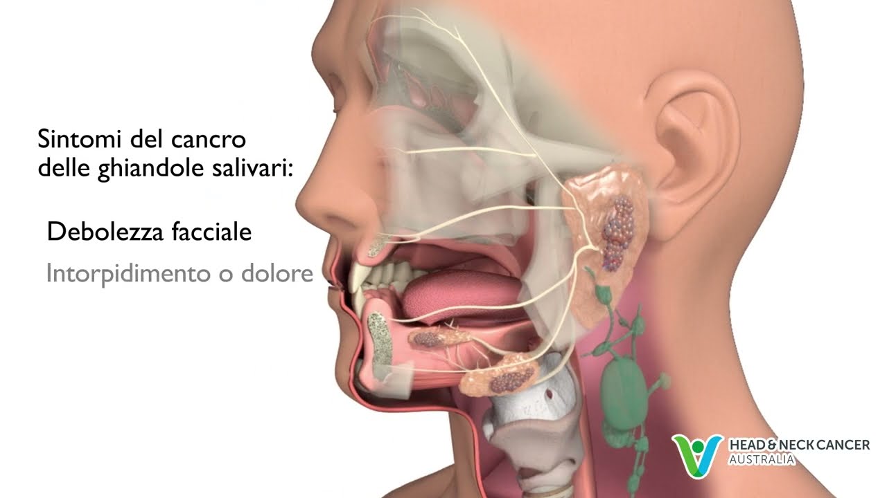 Italian - What is Salivary Gland Cancer? Signs & Symptoms. Head and Neck Cancer