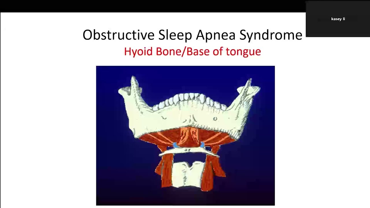 Почему челюстно-лицевая пластика при синдроме обструктивного апноэ сна оказывается неэффективной?