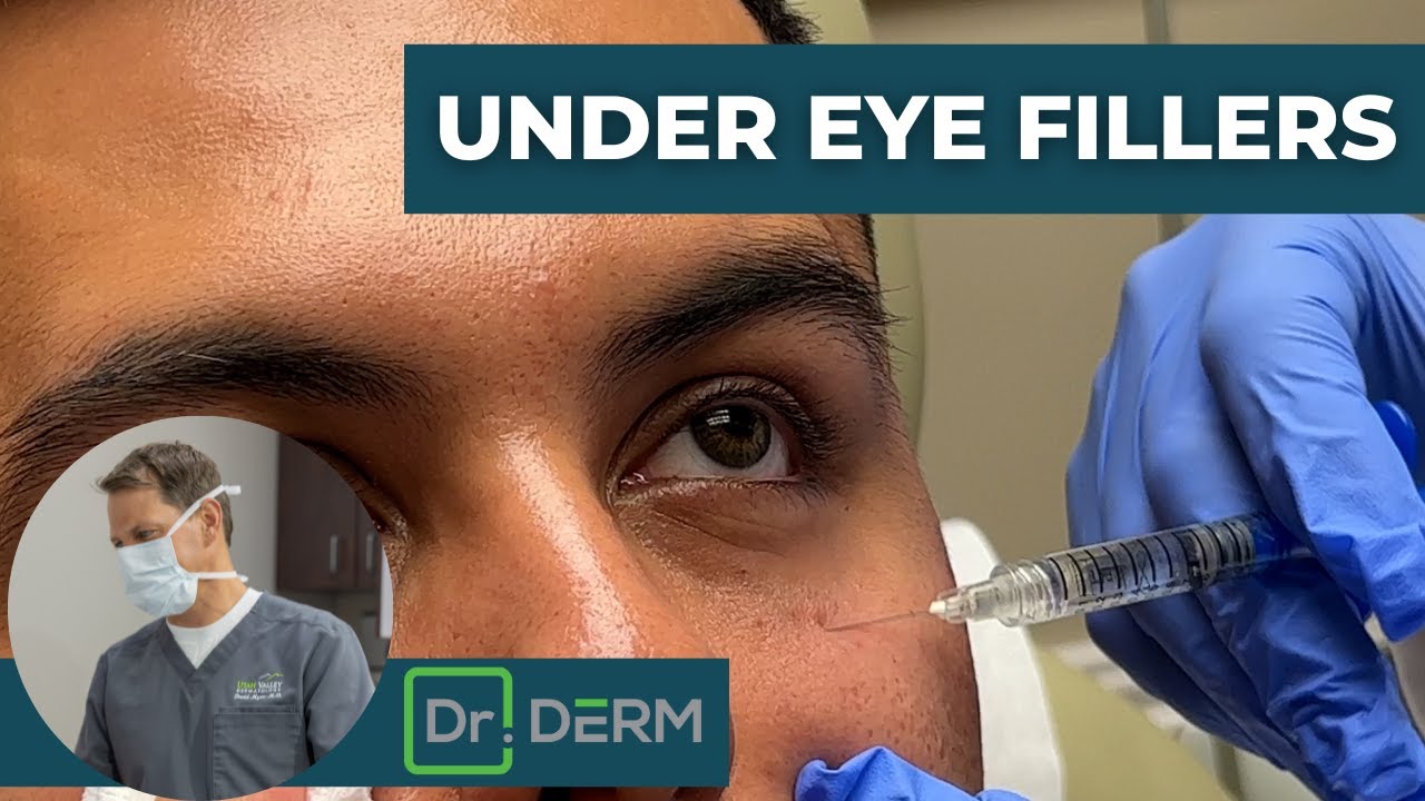 Under Eye Fillers by David Myers, MD FAAD | Bilayer Technique for Tear Trouges | Dr. Derm