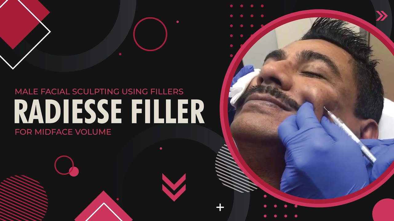 Male Facial Sculpting using Fillers | Radiesse Filler for Midface Volume | Beverly Hills, CA