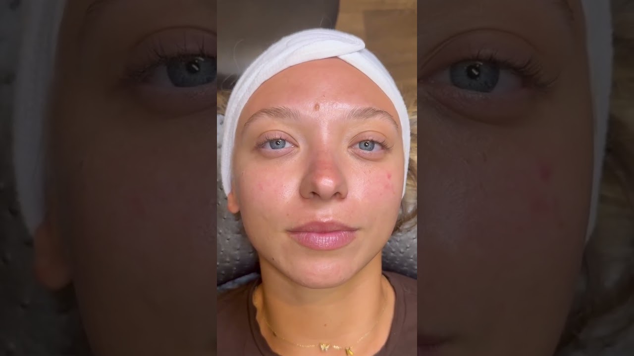 Before & after DermaFlash express facial. #facial #beforeandafter #dermaflash
