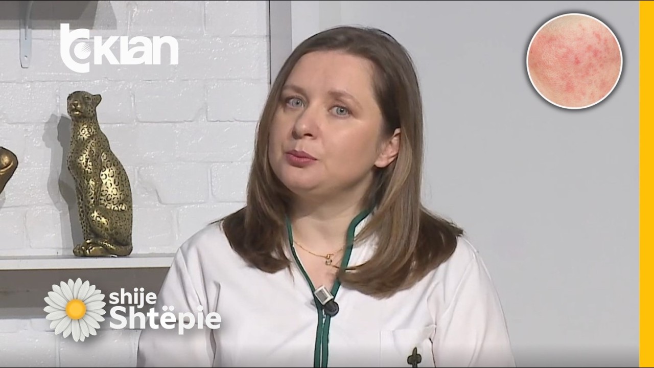 Shije Shtëpie - Çfarë është Rosacea, simptomat dhe si mund të trajtohet? - Tv Klan