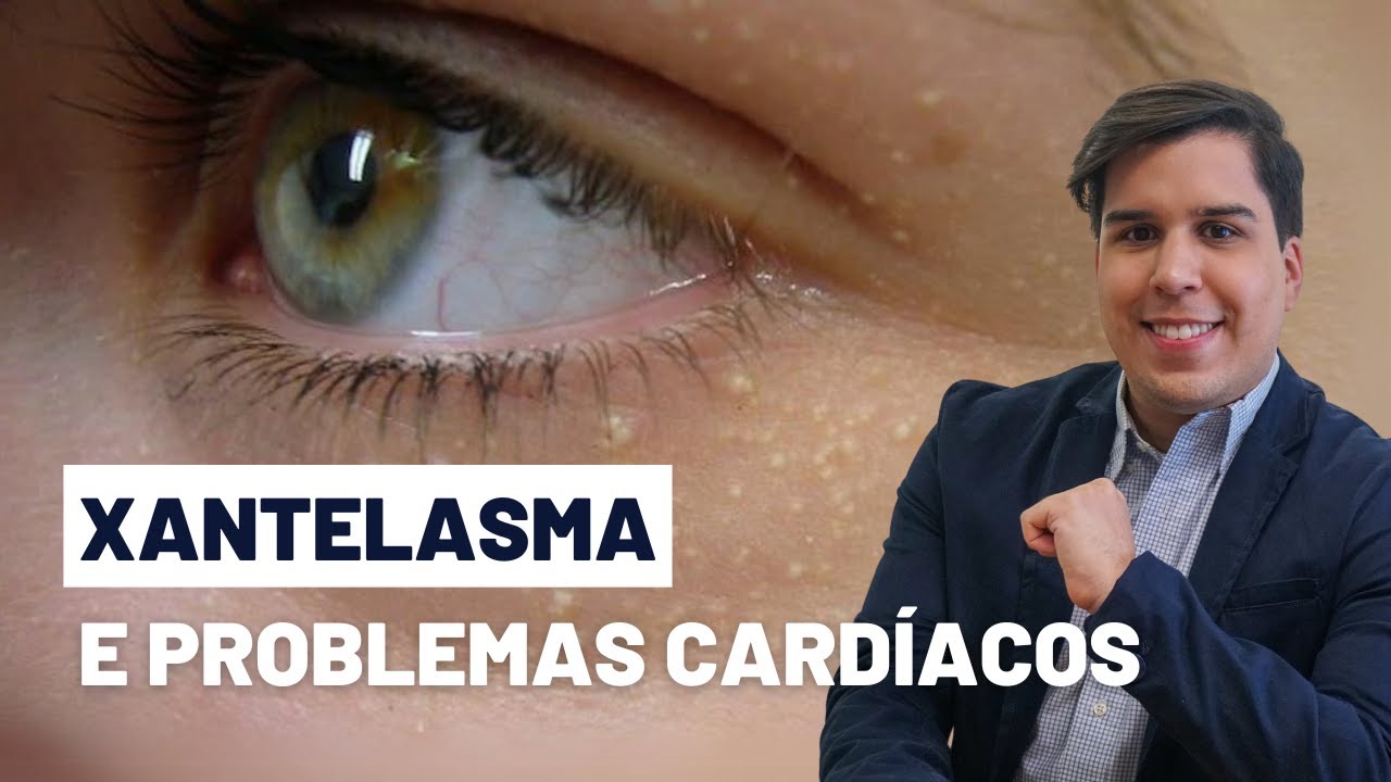 XANTELASMA E PROBLEMAS CARDÍACOS: O QUE VOCÊ PRECISA SABER
