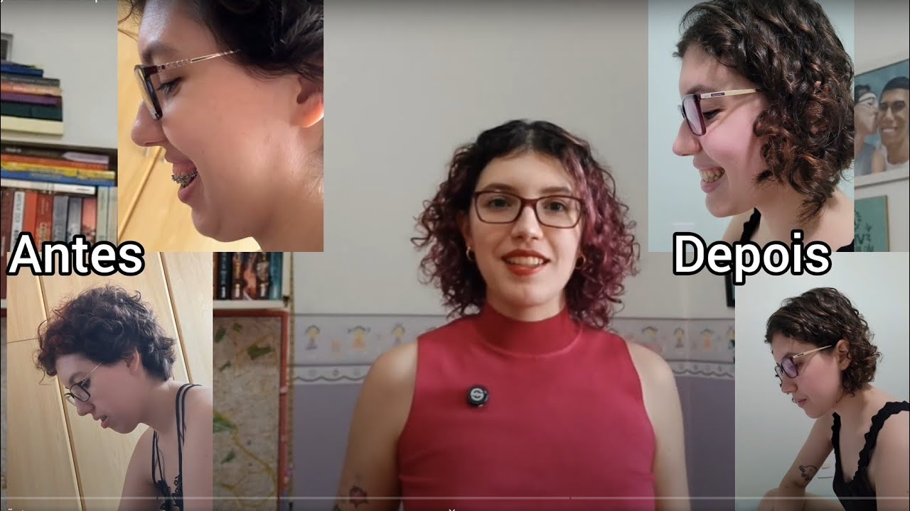 Antes e depois da cirurgia ortognática: valeu a pena?