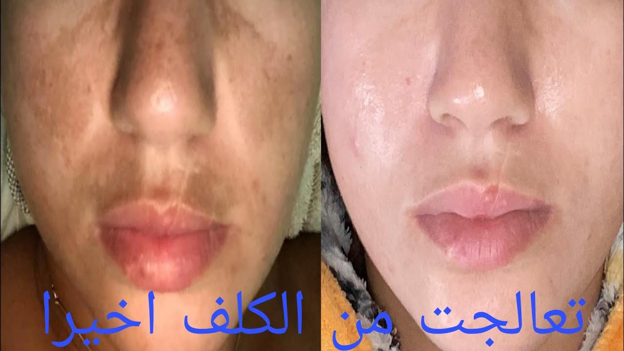 التصبغات الجلدية :العلاج حقيقة و ليس بالامر المستحيل