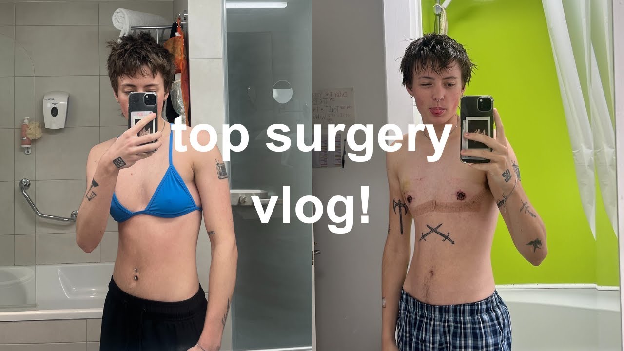 top surgery vlog!