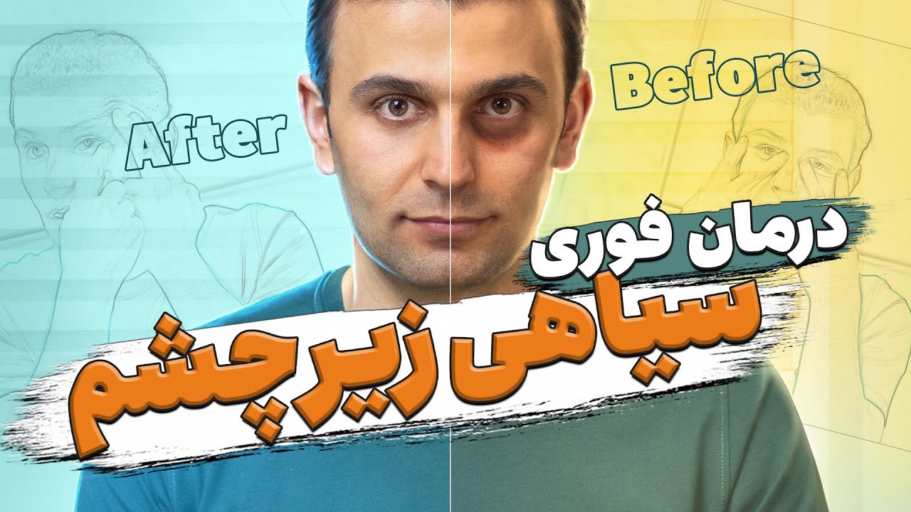 سیاهی و گودی زیر چشم را چگونه از بین ببریم؟ | How to get rid of under eye dark circles