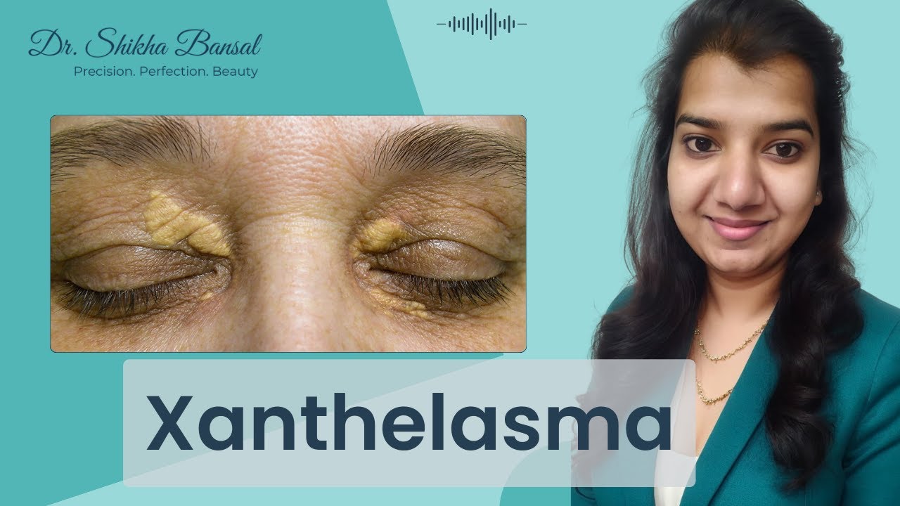 Xanthelasma क्या होता है? | Xanthelasma treatment & After Care | Plastic Surgeon in Gurgaon