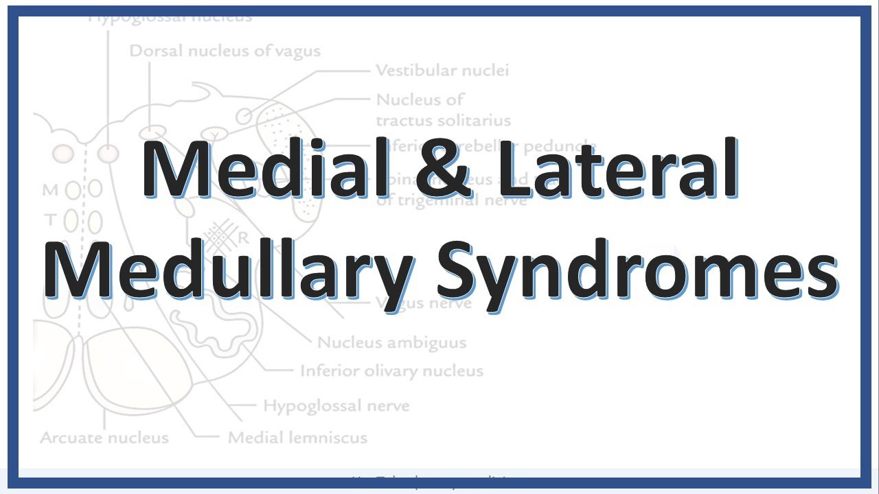 Lateral and Medullary Syndromes | Wallenberg Syndrome | PICA syndrome | Dejerine Syndrome