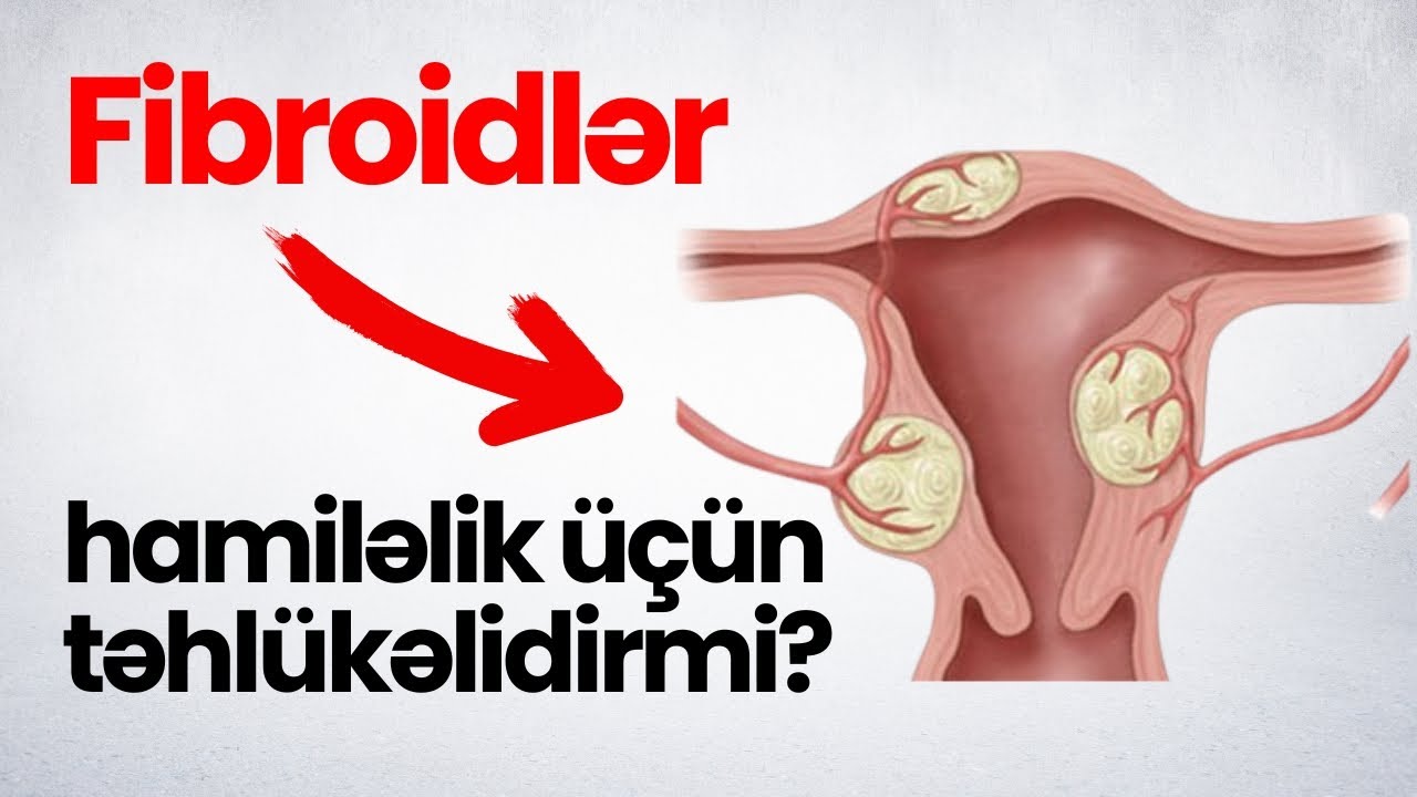 Fibroidlər (uşaqlıq əzələ şişləri) hamiləlik üçün təhlükəlidirmi?