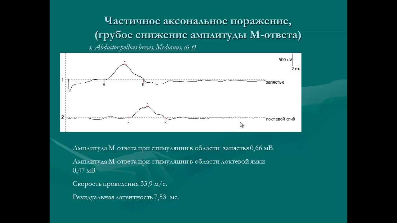Травмы нервов и электромиография
