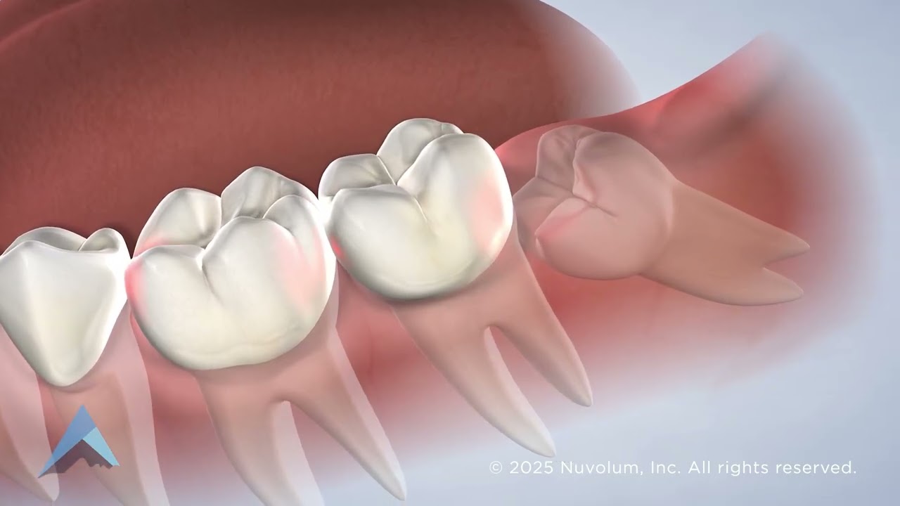 Wisdom Teeth Removal in Boise and Meridian, ID