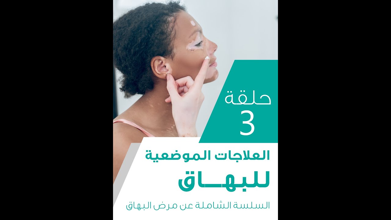 كل ما تريد معرفته عن كريمات علاج البهاق | السلسة الشاملة عن مرض البهاق | حلقة 3