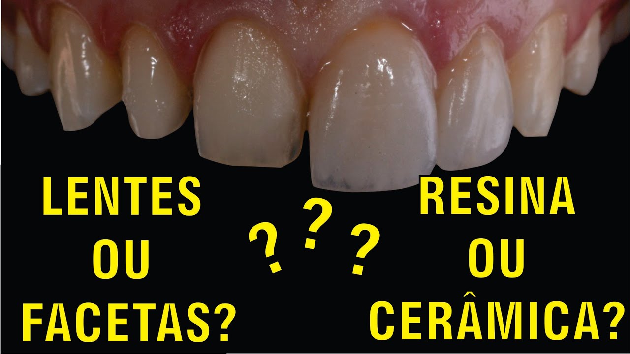 Lentes ou Facetas em Resina ou Cerâmicas?