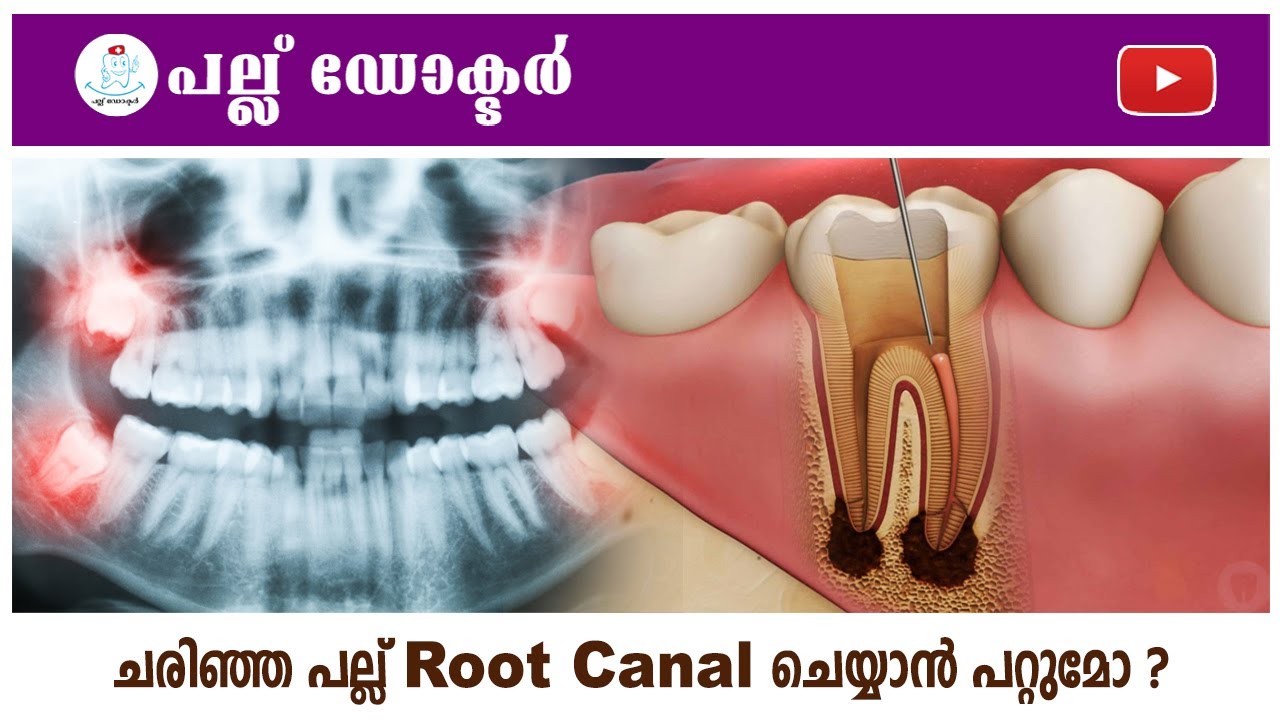 ചരിഞ്ഞ പല്ല് Root Canal ചെയ്യാൻ പറ്റുമോ? / Can a Crooked Tooth Undergo a Root Canal?