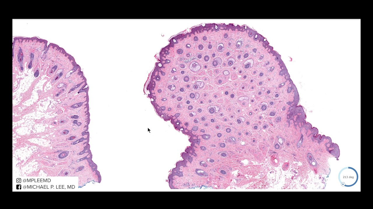 Accessory Tragus - an extra thing to pierce? Explained by a dermatopathologist.