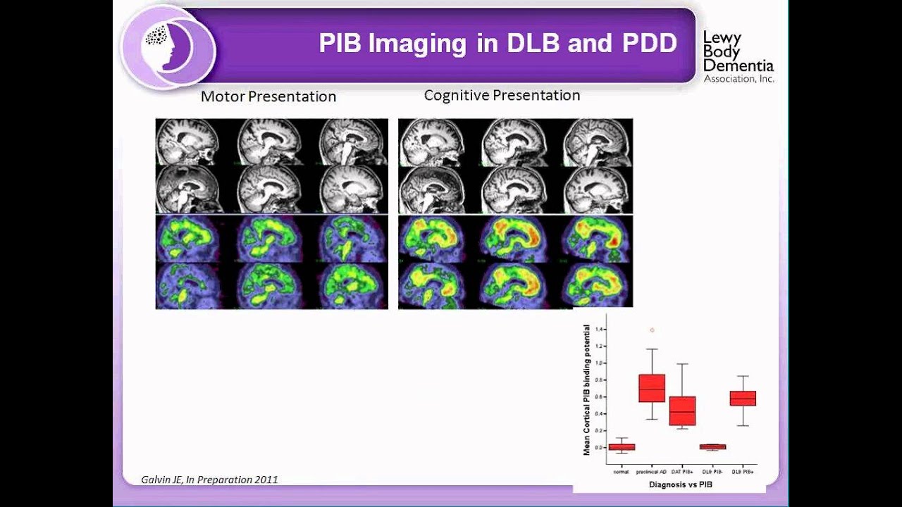 LBDA Webinar: New Insights into Lewy body dementias
