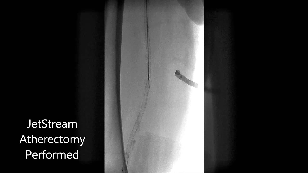 JetStream Atherectomy for In-Stent Restenotic Lesion