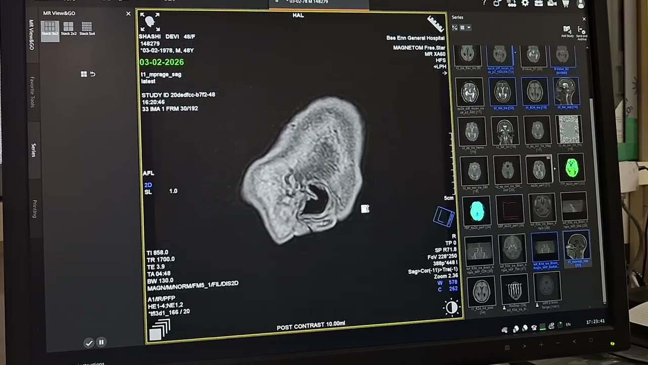 CYSTIC LESION NOTED IN MRI #CEMRI BRAIN#seimens #mri #radiology #bngh #jammu BNGH#J&k #hospital 