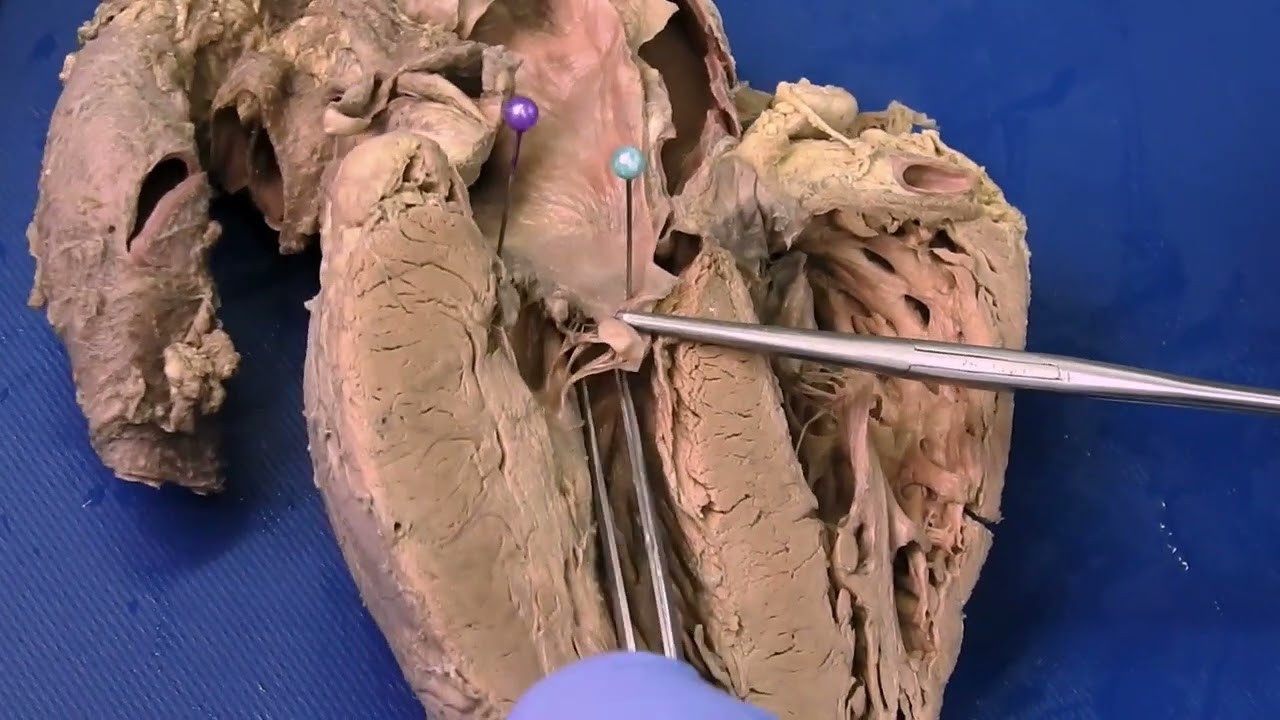 Morfología interna del corazón 2024. Vladimir Saldarriaga T.