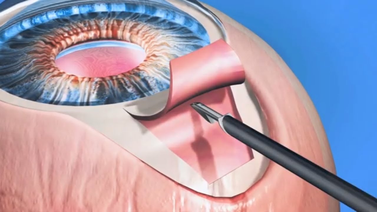 Introduction to the iStent Implant for Glaucoma | ADV Vision Centers