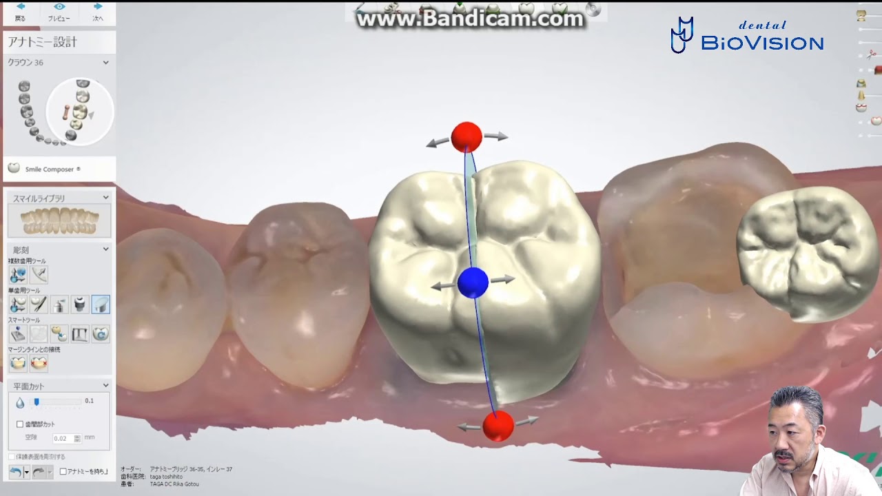 初級編「2根形態の大臼歯デザインを3shape Dental Systemで簡単におこなう方法」