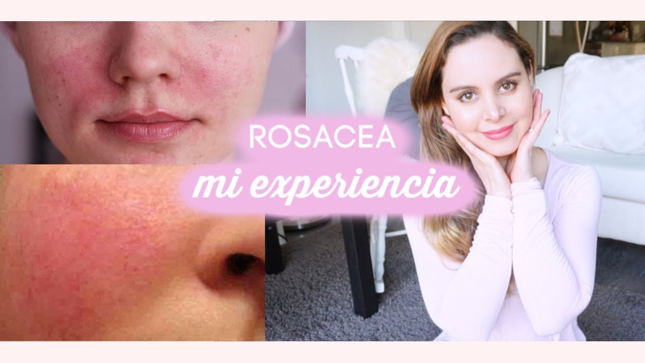 Todo Sobre la ROSACEA Mi Experiencia TRATAMIENTO , CREMAS
