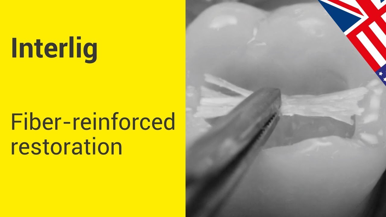 INTERLIG - Fiber-reinforced restoration