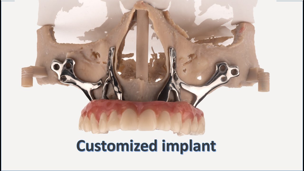 Customized implant with screw retain prosthesis  for Atrophic Bone