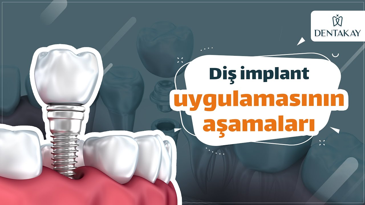 Dentakay | Diş İmplant uygulamasının aşamaları