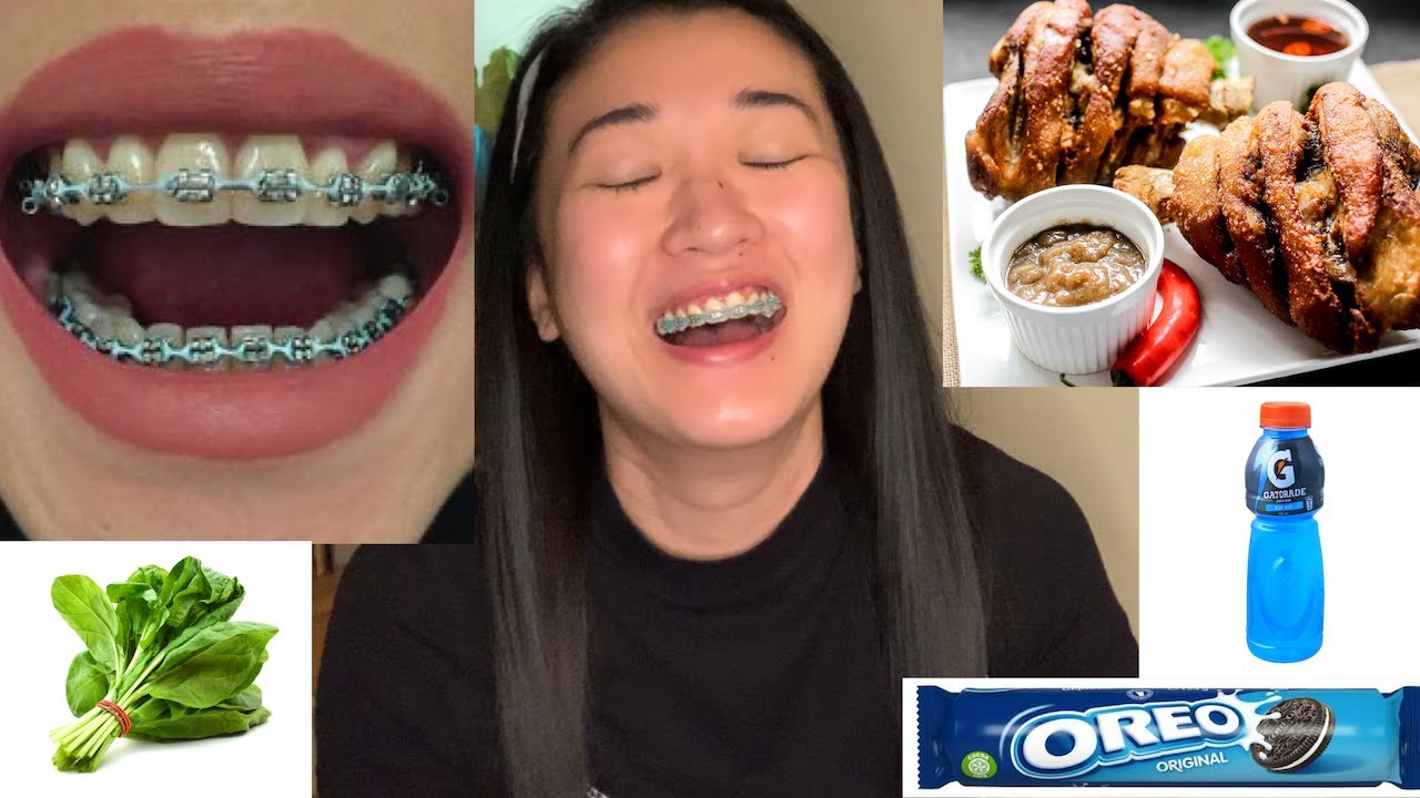 Usapang Braces: Mga pagkaing hassle at dapat iwasan + Tips para tanggal agad ang tinga mo!