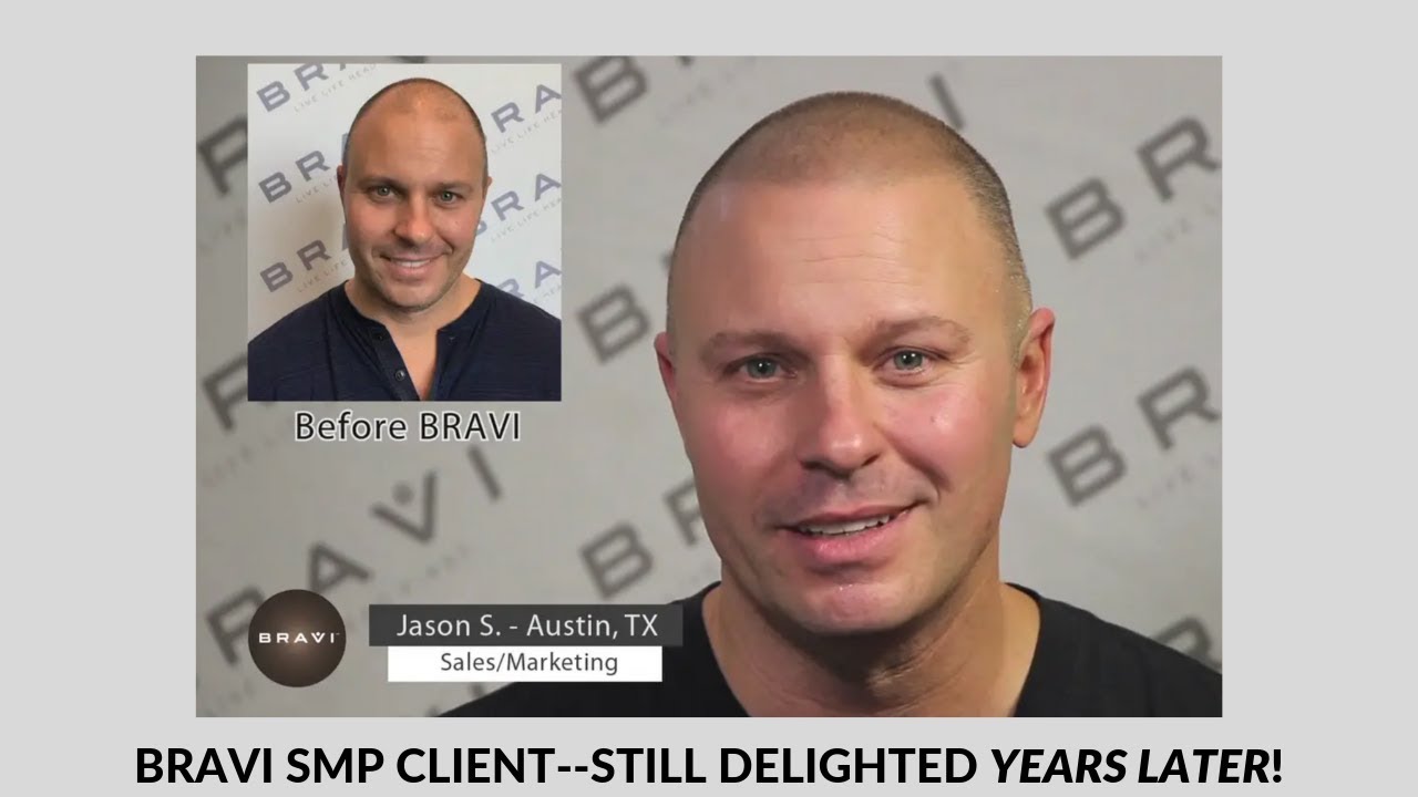 BRAVI Scalp MicroPigmentation (SMP) Client-- Still Happy 4 YEARS LATER!