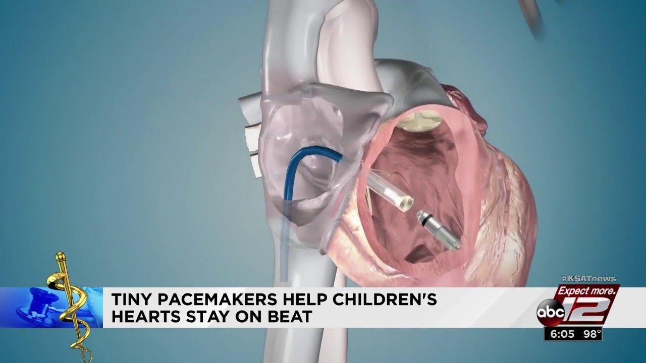 Video: Cardiologists using tiny pacemaker for kids with congenital heart disease
