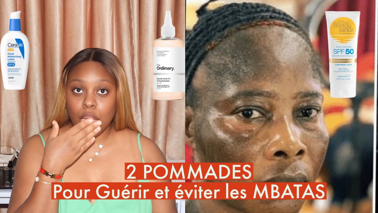 Comment guérir et éviter l’hyper pigmentation , les sunburns , les mbatas les discolorations