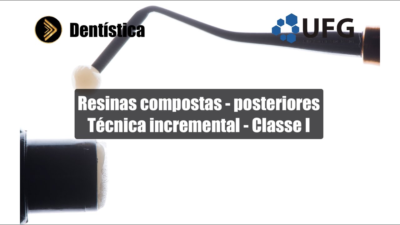 Restauração de resina composta - Técnica Incremental Oblíqua.