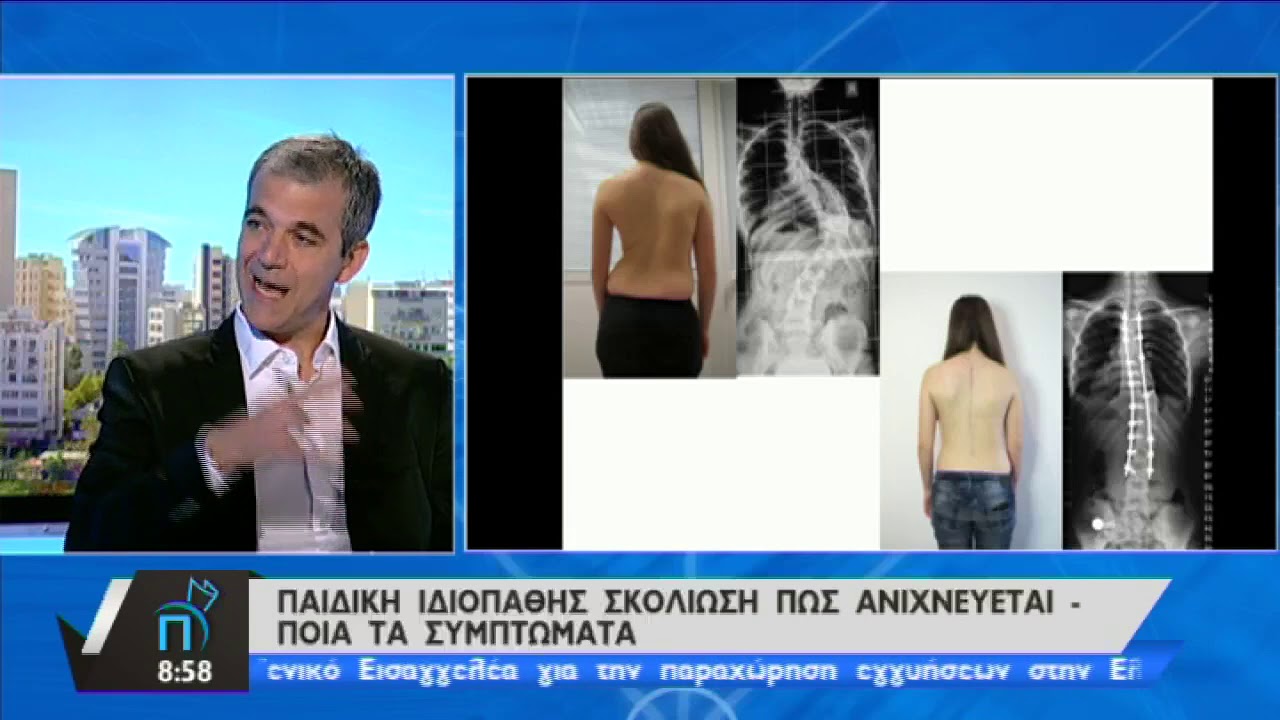 Παιδική Ιδιοπαθής Σκολίωση, πως ανιχνεύεται και ποια τα συμπτώματα - Ηλίας Παπαδόπουλος