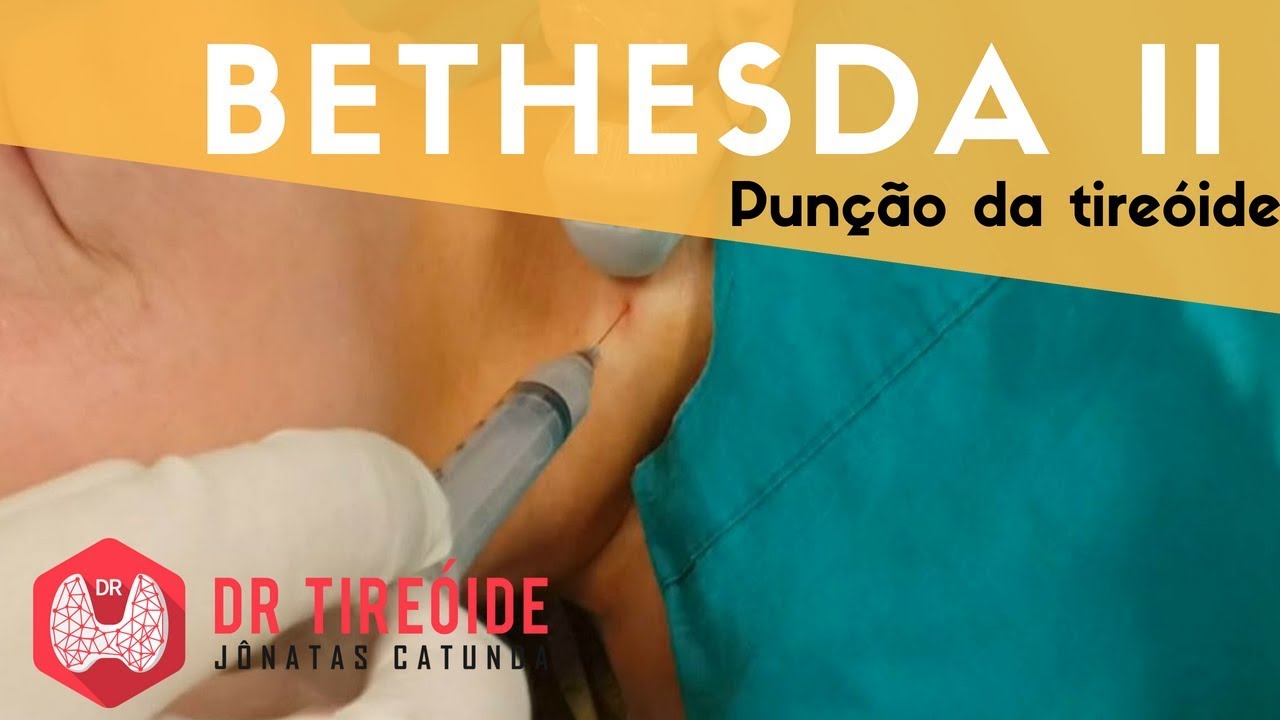 PAAF da tireóide Bethesda II - Resultado BENIGNO!!!  | Dr Jônatas Catunda