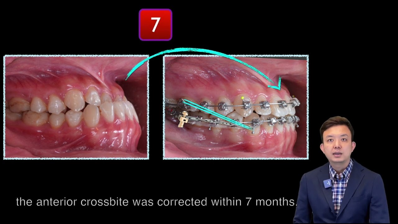 Severe Class III with -4 mm Overjet：OGS vs Ortho only｜【Chris Chang Ortho】CC702