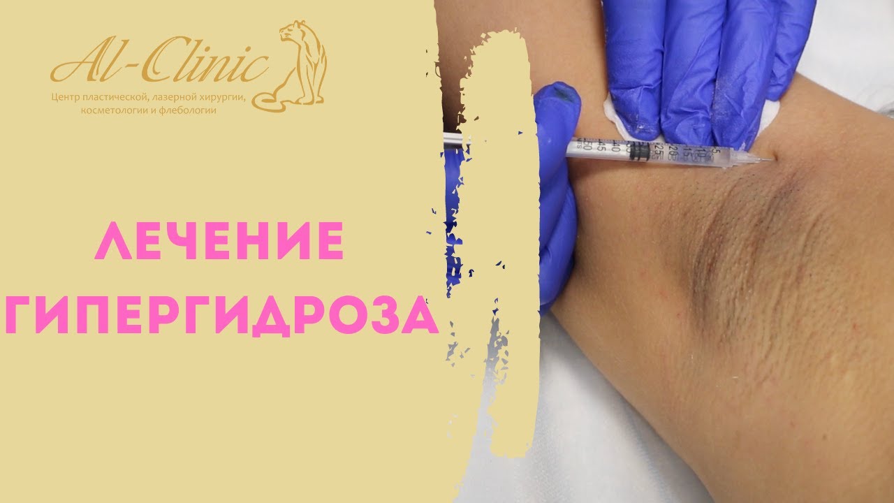 ЛЕЧЕНИЕ ПОВЫШЕННОЙ ПОТЛИВОСТИ💦 | Проба Минора | Лечение гипергидроза💉
