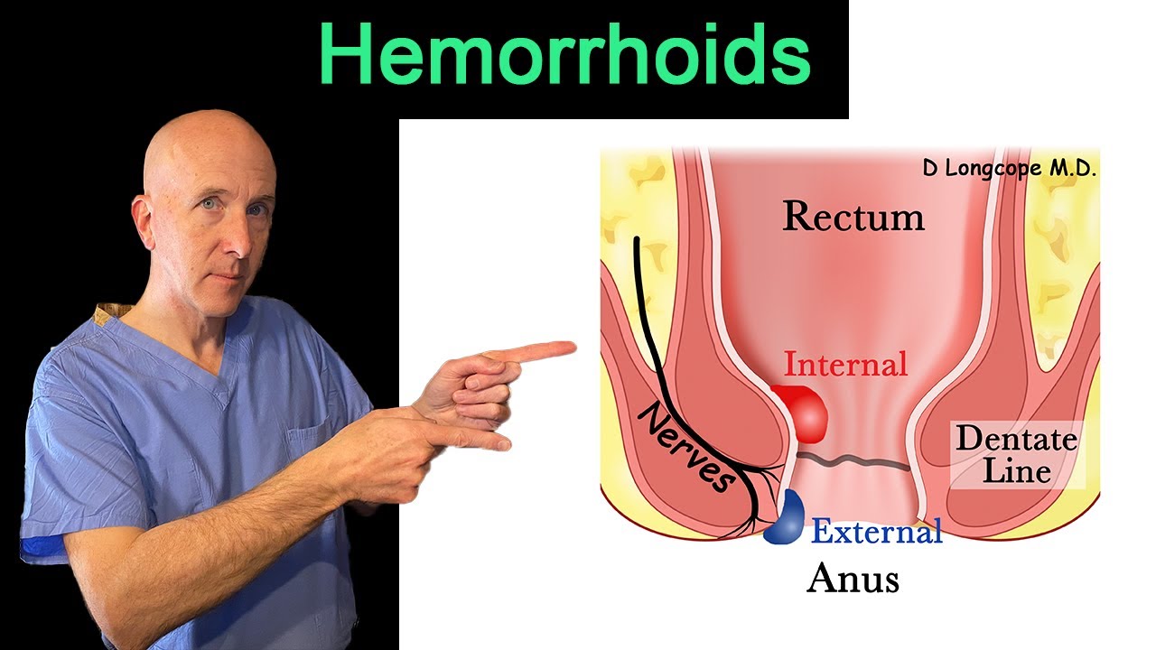 Complete overview of Hemorrhoids