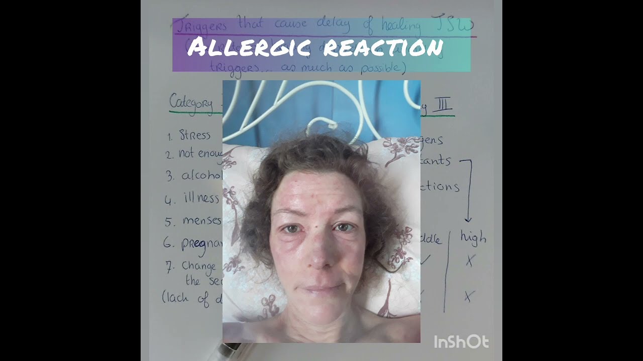 Triggers that delay the healing of  Topical Steroid Withdrawal - TSW