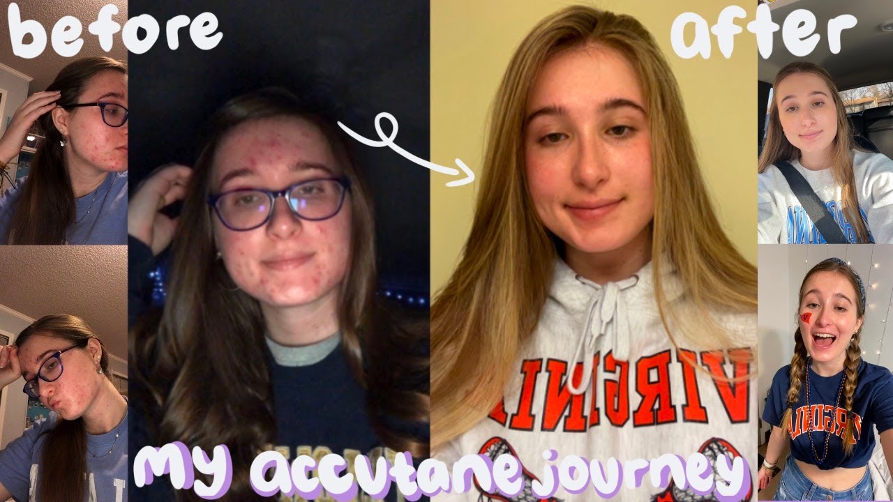 my accutane journey: how i cleared my skin from severe acne and gained self confidence