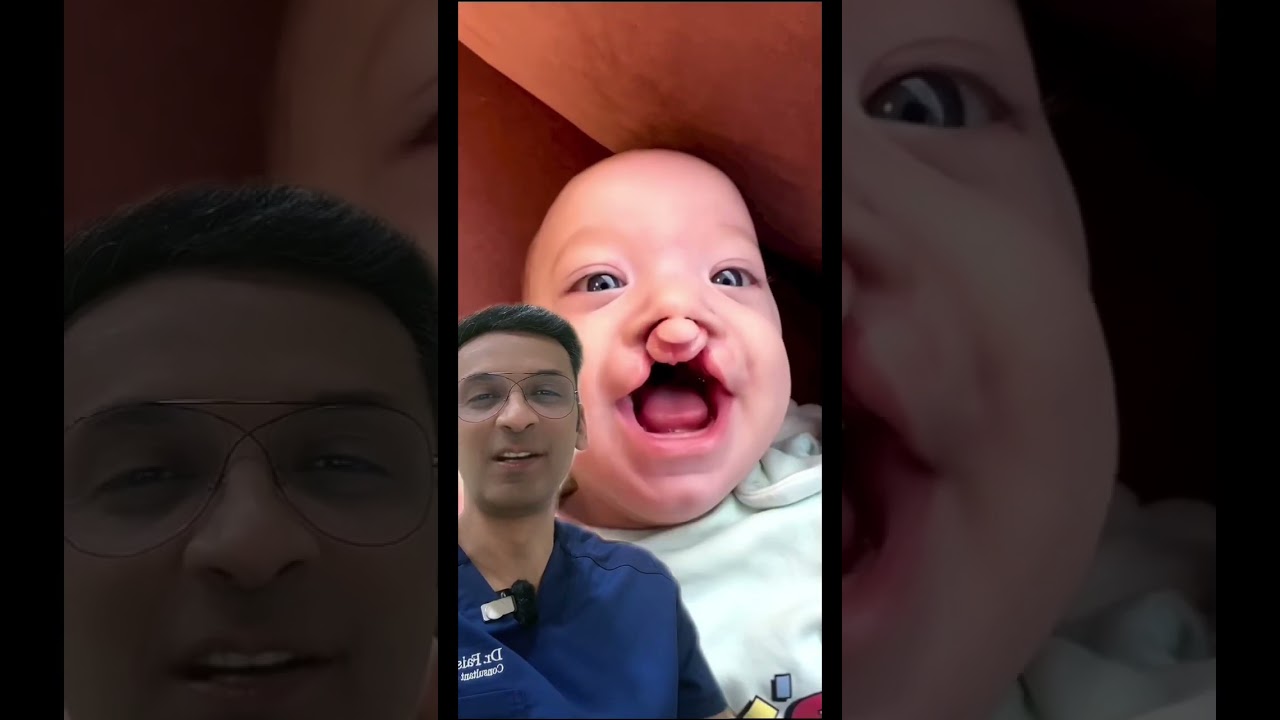 A case of bilateral cleft lip and palate.
